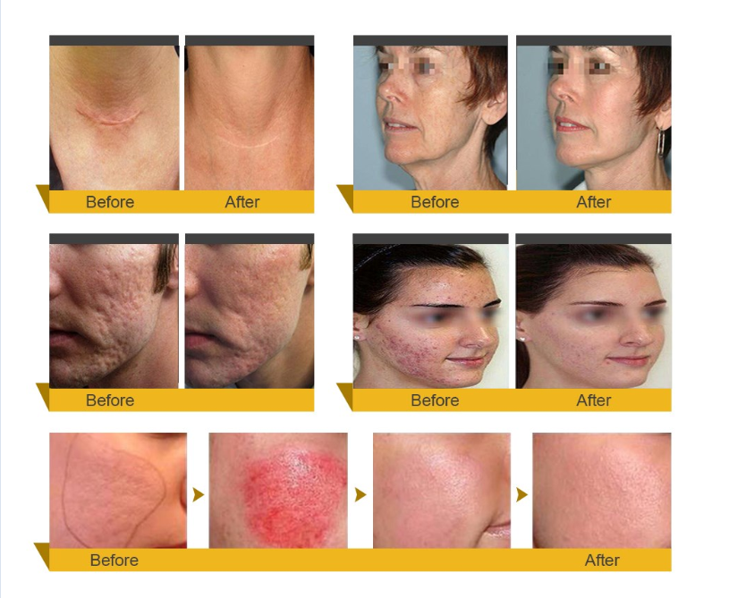 Contact Supplier Chat Now! Fractional Infini Rf Stretch Mark Radio Frequency Microneedle Machine With Two Treatment Heads Contact Supplier Chat Now! Fractional Infini Rf Stretch Mark Radio Frequency Microneedle Machine With Two Treatment Heads