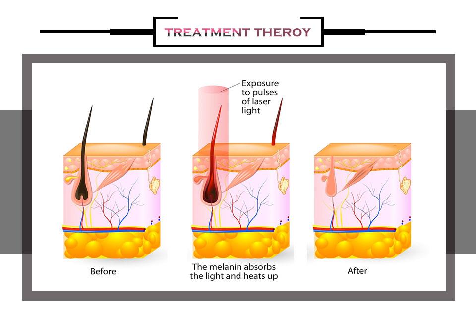 Sanhe Diode Laser Hair Removal Machine Sanhe Diode Laser Hair Removal Machine