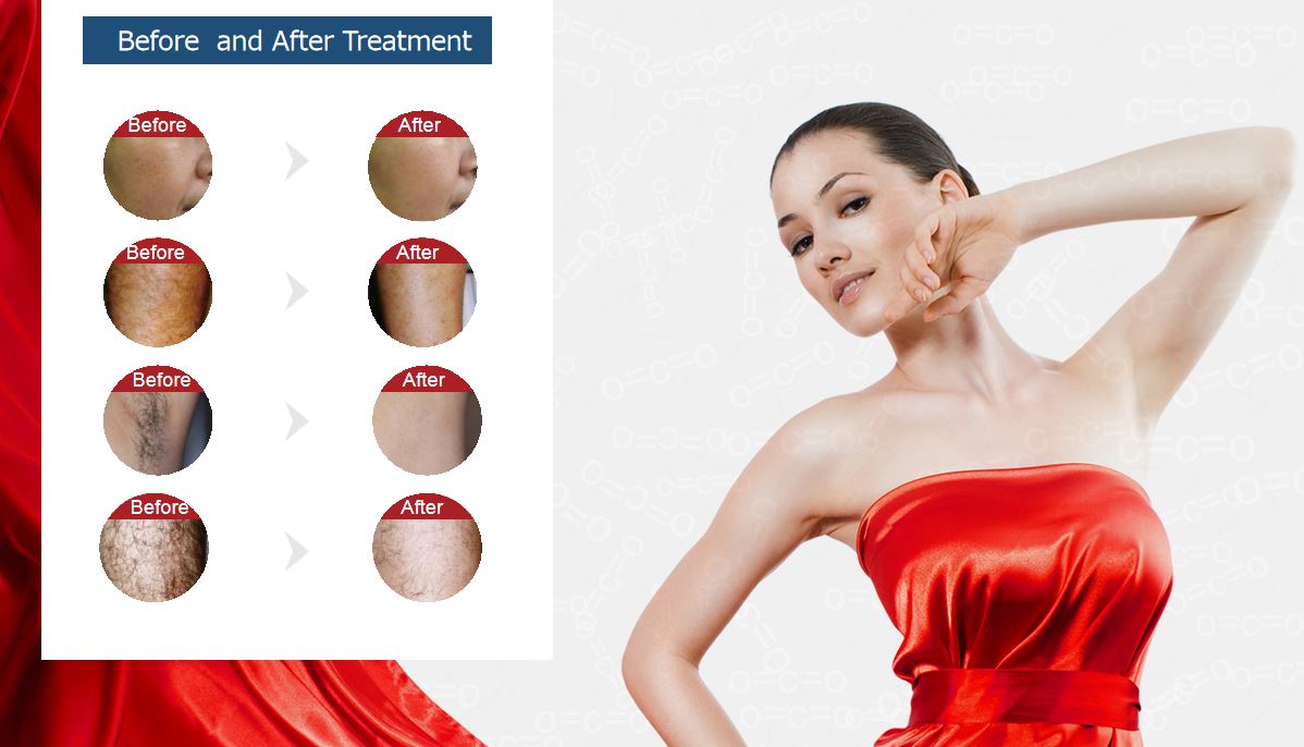 Sanhe P-mix Hair Removal Machine Sanhe P-mix Hair Removal Machine