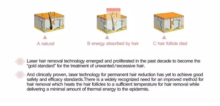 Pain Free Laser Hair Removal Machine